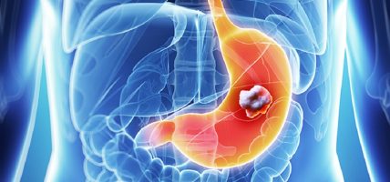 चीनमा सिटि स्क्यानमार्फत पेटको क्यान्सर पहिचान सम्भव, एआई ‘डामो ग्रेप’ को सफलता