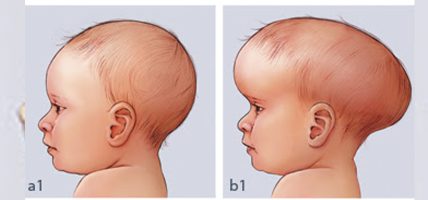 वीर अस्पतालमा डिजिटल प्रविधिबाट टाउको शल्यक्रियाको सफलता
